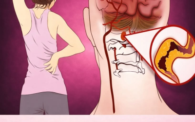 10 včasných varovných signálů mrtvice, které by měl znát každý, aby mohl včas jednat