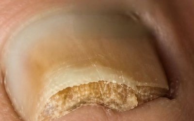 Elimina los hongos de las uñas de forma permanente se 2 přírodními složkami.