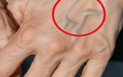 Hrbolky na rukou: znamení, které by vaše tělo nemělo ignorovat