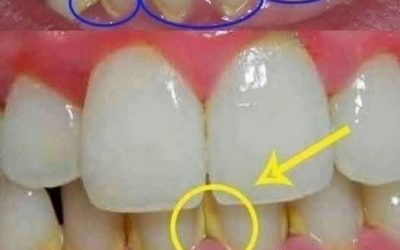 Odstraňte zubní plak přirozeně: Jednoduché tipy pro lepší ústní hygienu