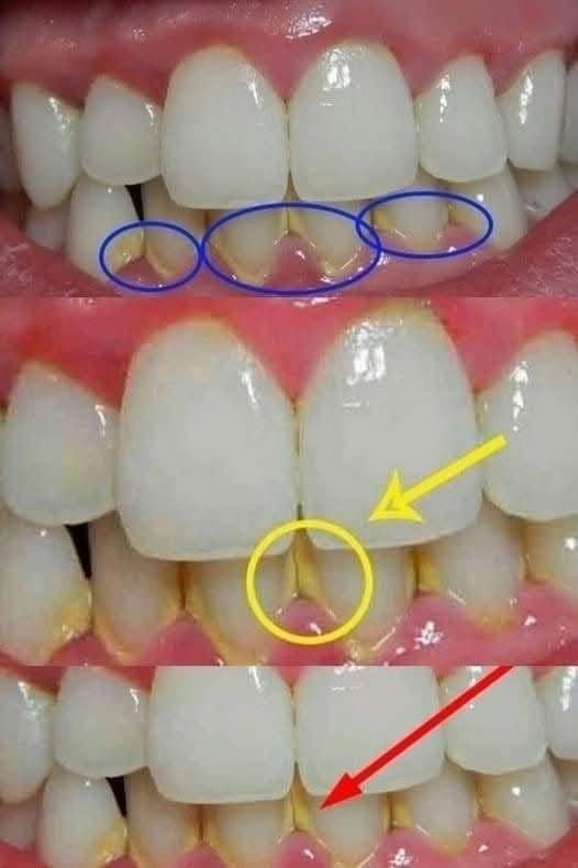 Odstraňte zubní plak přirozeně: Jednoduché tipy pro lepší ústní hygienu