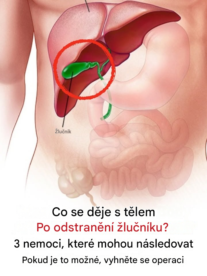 Co se děje s tělem po odstranění žlučníku? 3 nemoci, které mohou následovat – pokud je to možné, vyhněte se operaci