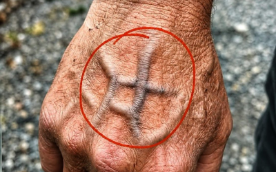 Kdy byste se měli znepokojovat žilkami, které se náhle objeví?