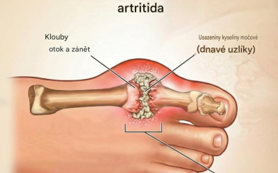 7 přírodních způsobů léčby kyseliny močové způsobující artritidu
