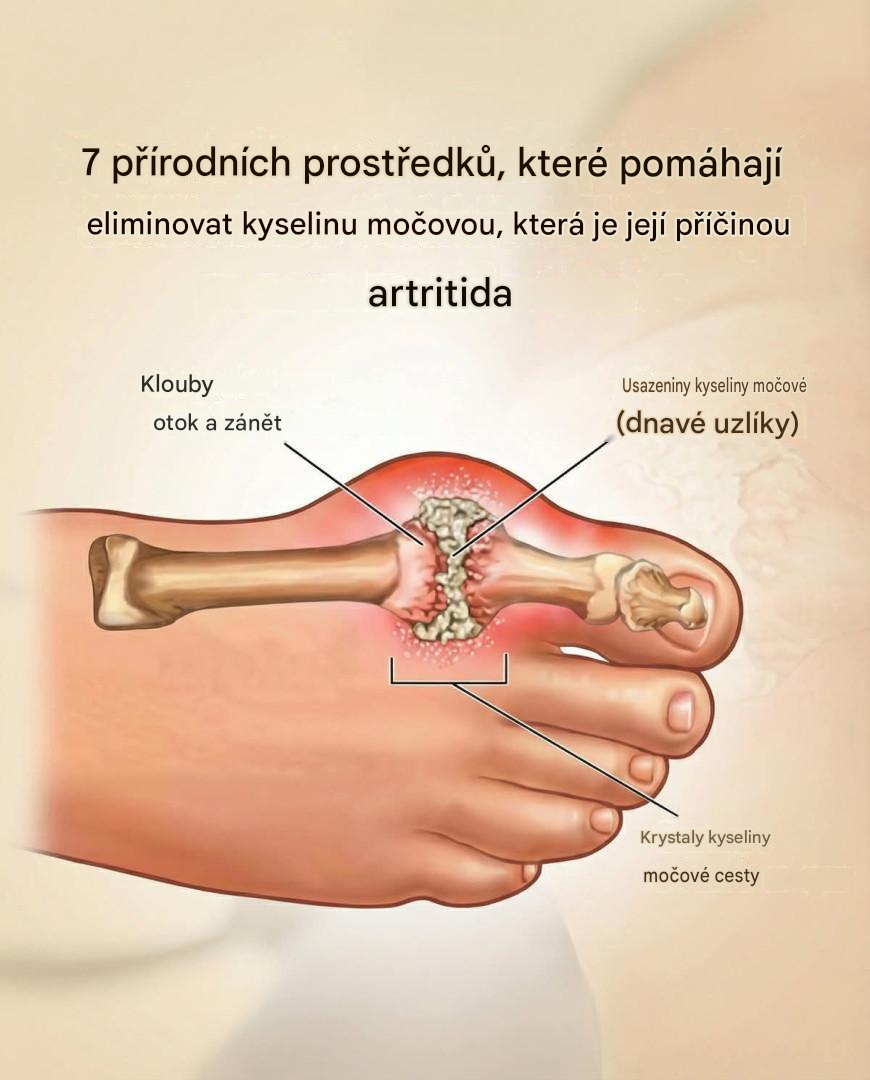 7 přírodních způsobů léčby kyseliny močové způsobující artritidu