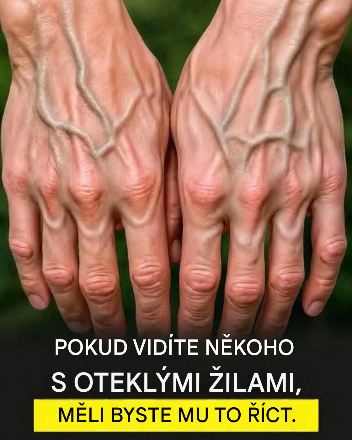 Pokud máte viditelné žíly, znamená to, že… Zobrazit více