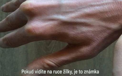 Vysvětlení viditelných žil: běžné příčiny, zdravotní rizika a kdy se obávat.