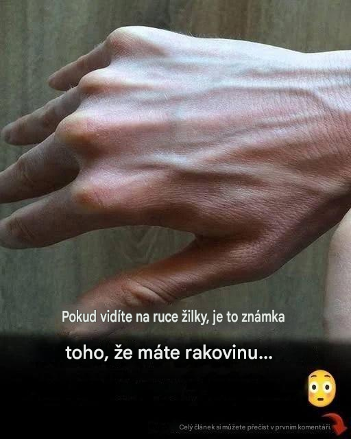 Vysvětlení viditelných žil: běžné příčiny, zdravotní rizika a kdy se obávat.