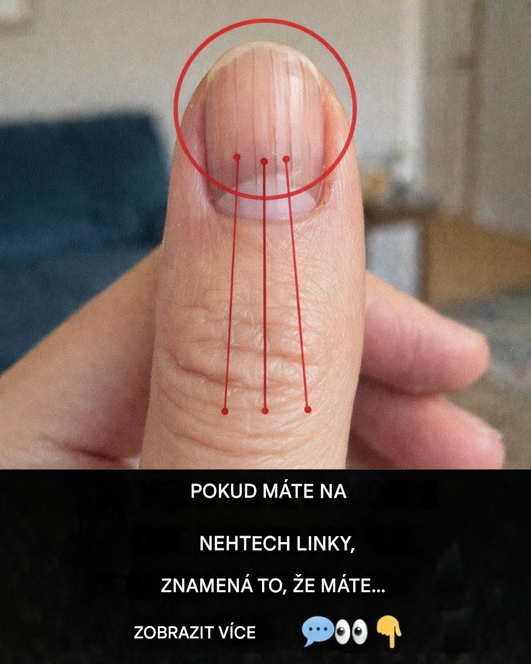 Linky na nehtech: Co mohou prozradit o vašem zdraví