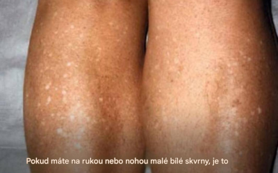 Proč se mi v létě objevují bílé skvrny na kůži a jak je mohu léčit? Odpověď nabízí dermatolog.