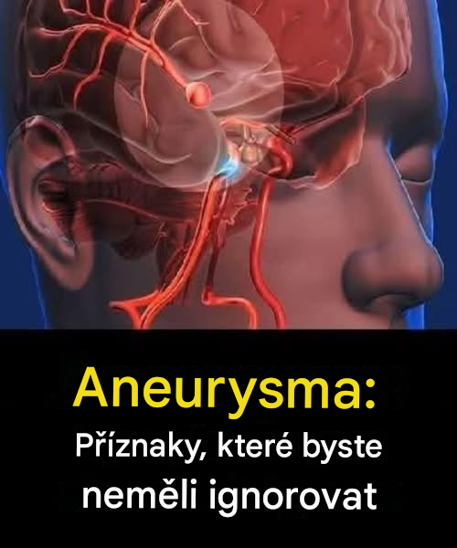 Aneuryzma: Příznaky, které byste neměli ignorovat…