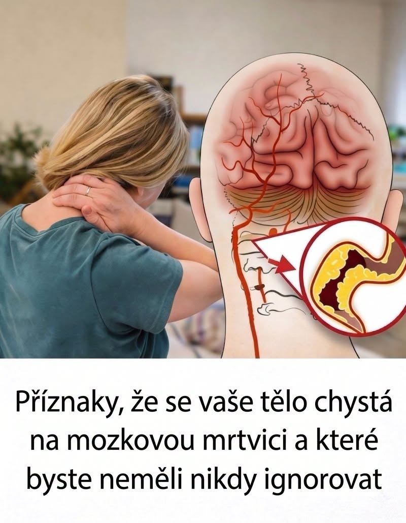 10 varovných příznaků cévní mozkové příhody, které by měl znát každý, aby mohl včas zasáhnout